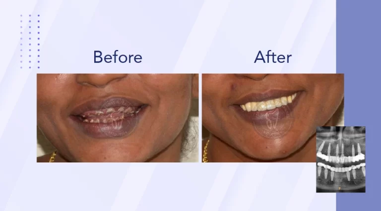 F&F Dental Website services banner resize_phone size-03